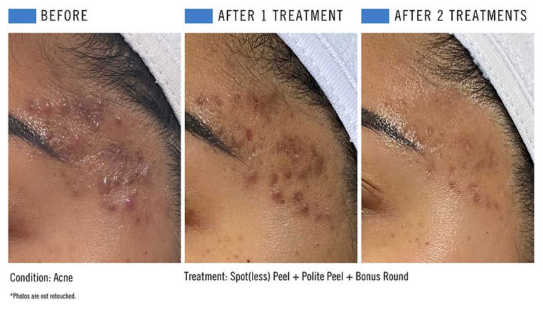 Spotless + Polite Peel - 1 & 2 Treatments.jpg