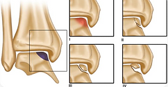 lesão osteocondral talus
