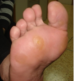 calosidades metatarsalgia