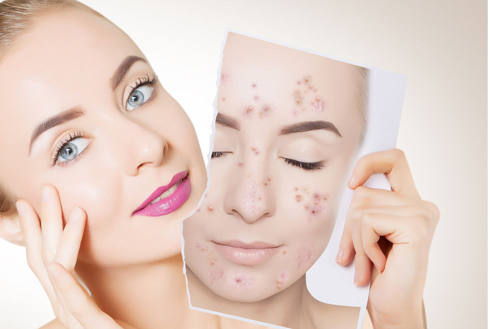 Understanding Acne Across Different Ages and Life Stages