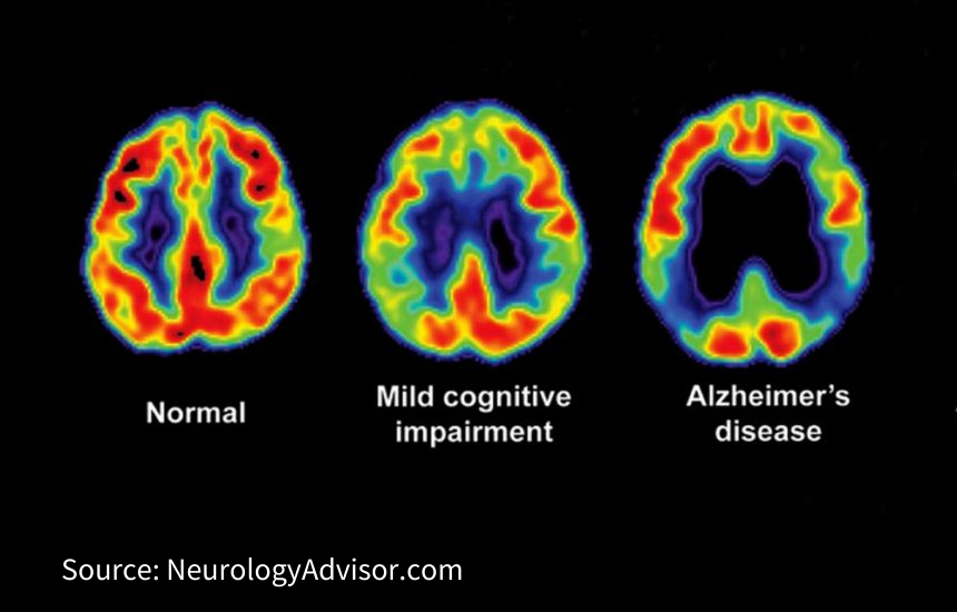 PET scans of individuals with normal cognitive abilities, MCI, and Alzheimer's