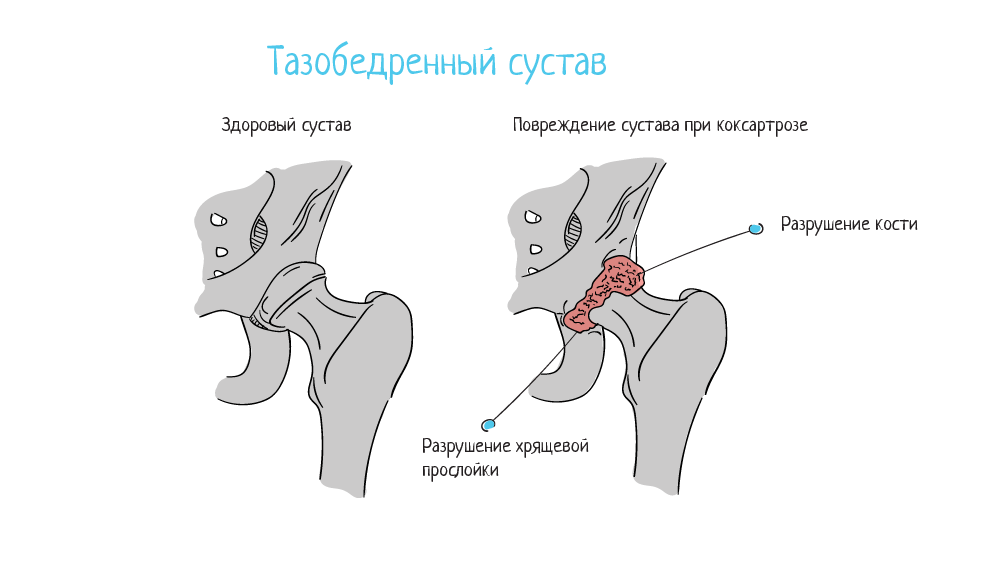 Что такое тендиноз тазобедренного сустава