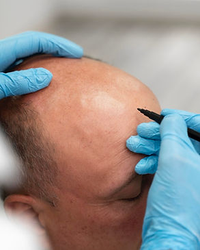 man-going-through-follicular-unit-extraction-process (1) Large.jpeg