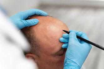 man-going-through-follicular-unit-extraction-process (1) Large.jpeg