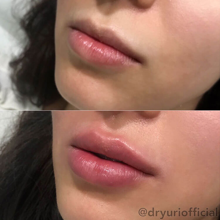 Before and after lip filler showing fuller, more defined lips with enhanced volume and symmetry.