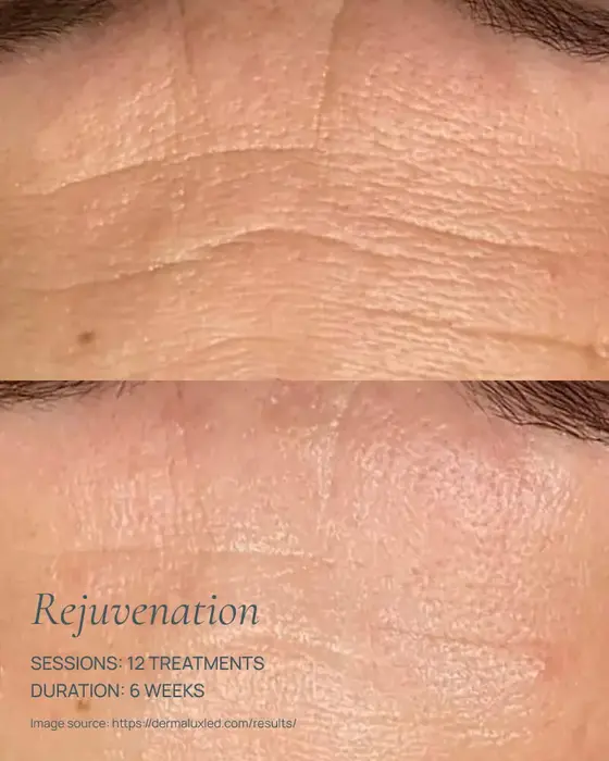 before and after dermalux red light therapy rejuvenation of forehead skin