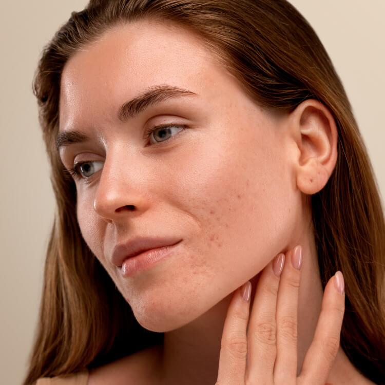 Close-up of a young woman with clear skin and mild acne scars on her cheeks, gently touching her neck and looking away from the camera