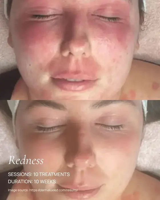 before and after dermalux red light therapy healing of redness on face