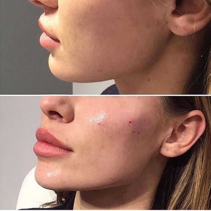 Before and after cheeks filler showing enhanced jawline definition.