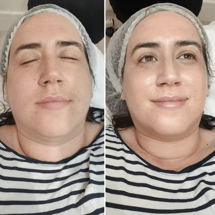 Before and after comparison of a woman receiving a face spa treatment. The 'after' photo shows visibly brighter, smoother, and more hydrated skin with a healthy glow