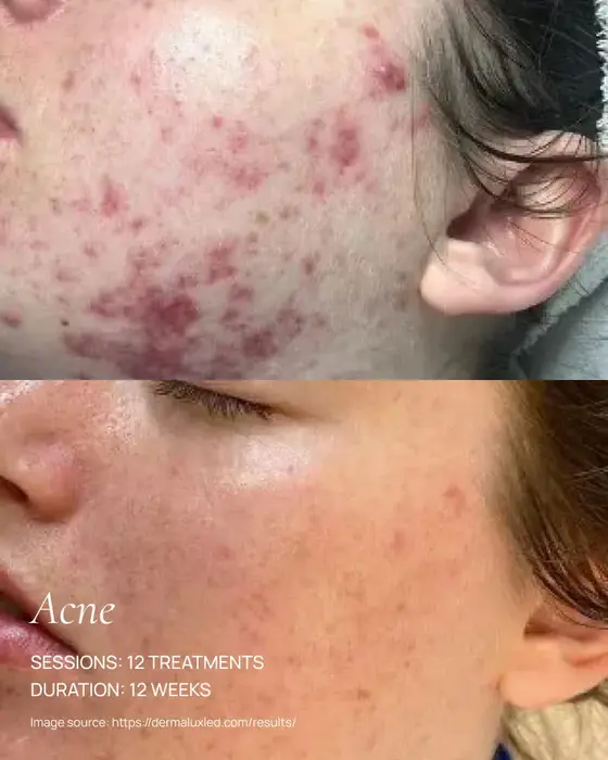 before and after dermalux red light therapy healing of acne prone skin