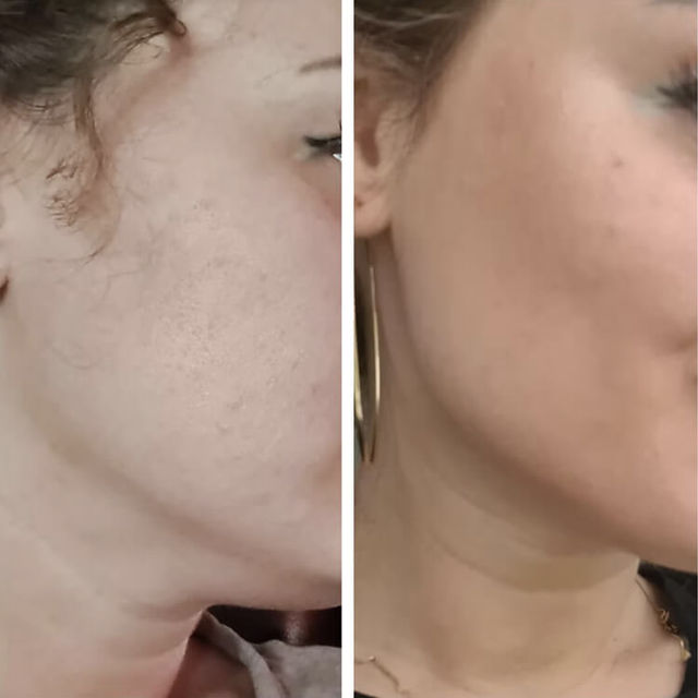 Aqualyx | Elyse Beauty & Laser Clinic in Lewisham