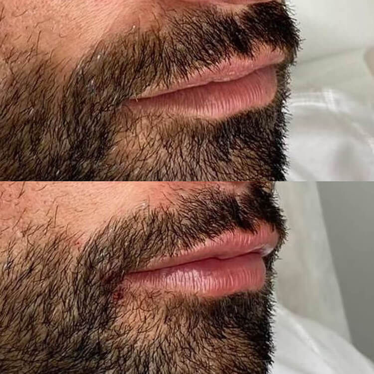 Close-up before and after image of a man's lips showing increased volume and definition after lip filler treatment.