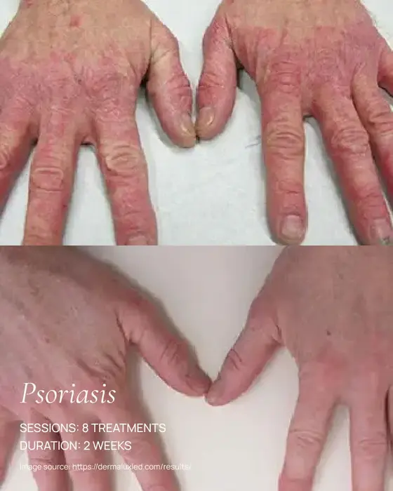 before and after dermalux red light therapy healing of psoriasis on hands