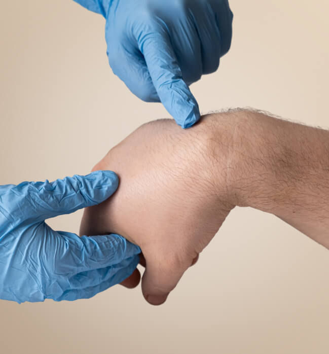 Doctor wearing medical gloves examining a cyst or lipoma on a patient’s hand.
