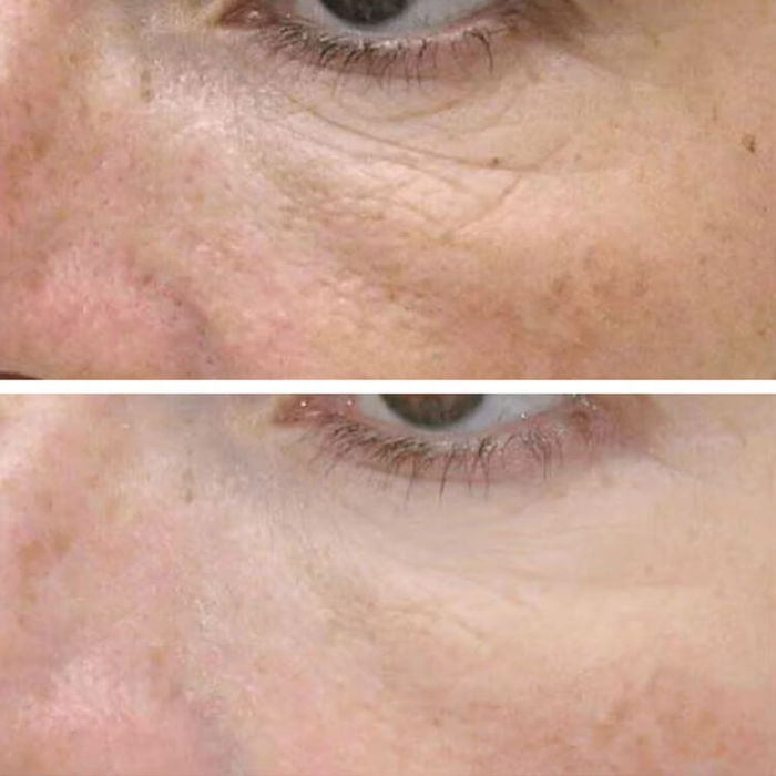 Close-up before and after image showing visible reduction of fine lines, wrinkles, and pigmentation under the eye following mesotherapy treatment