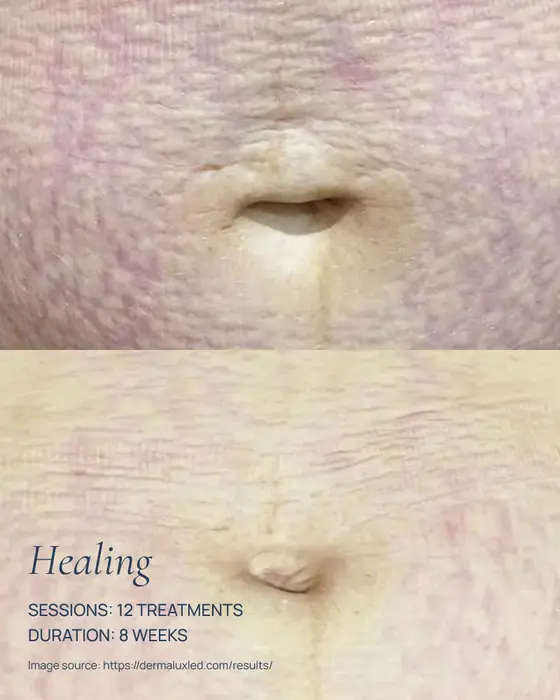 before and after dermalux red light therapy healing of stretch marks on the abdomen skin