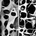 Osteoporosis - Infinite Health