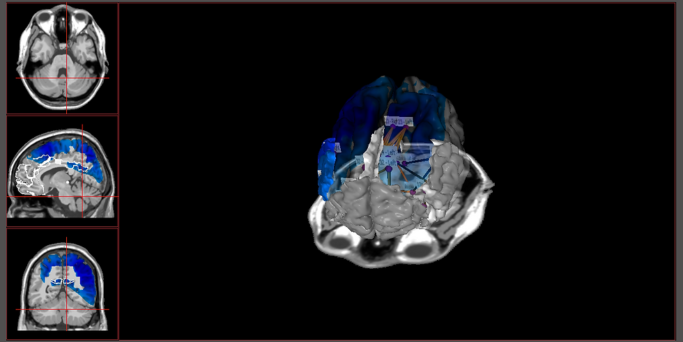 A 3-diensional view of a brain from different angels with the color blue on different regions of the brain. This is a brain map that helps a neurofeedback therapist in katy, tx provide accurate neurofeedback therapy in katy, tx 77494.