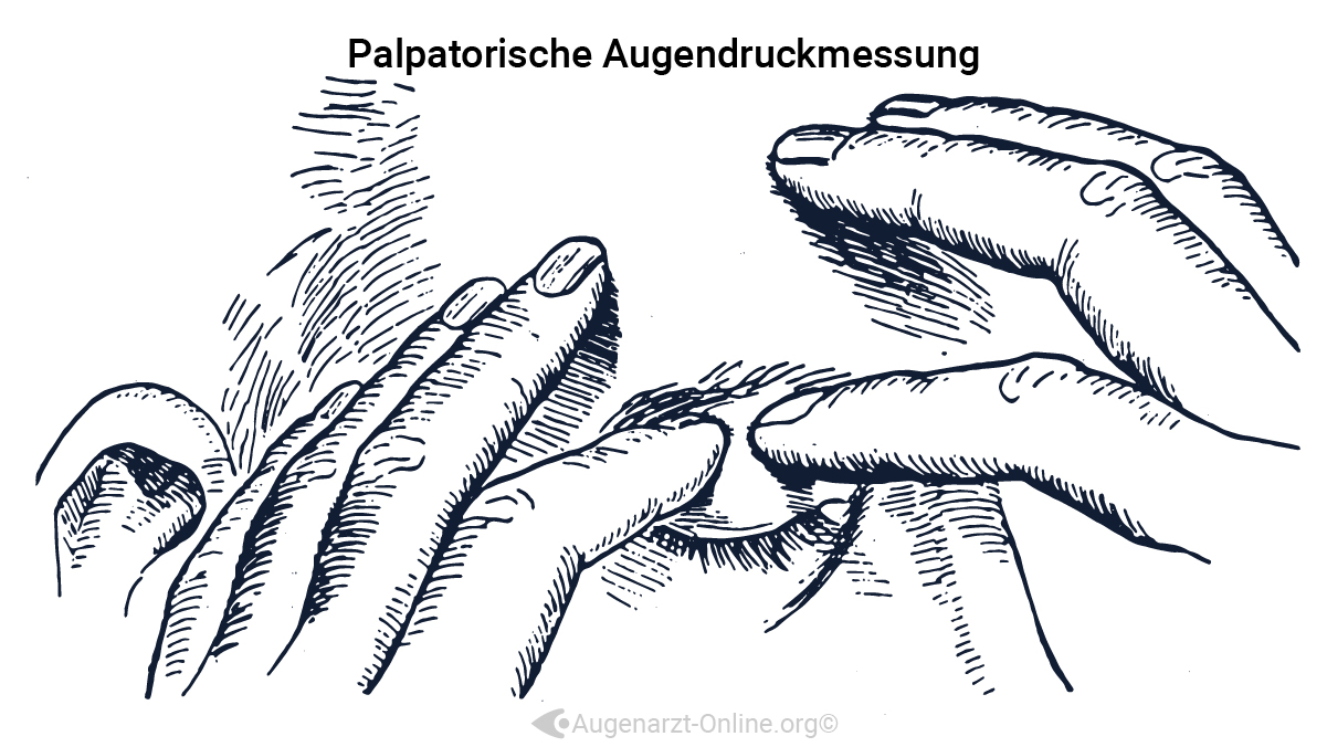 Palpatorische Augendruckmessung zur Bestimmung des Augeninnendrucks
