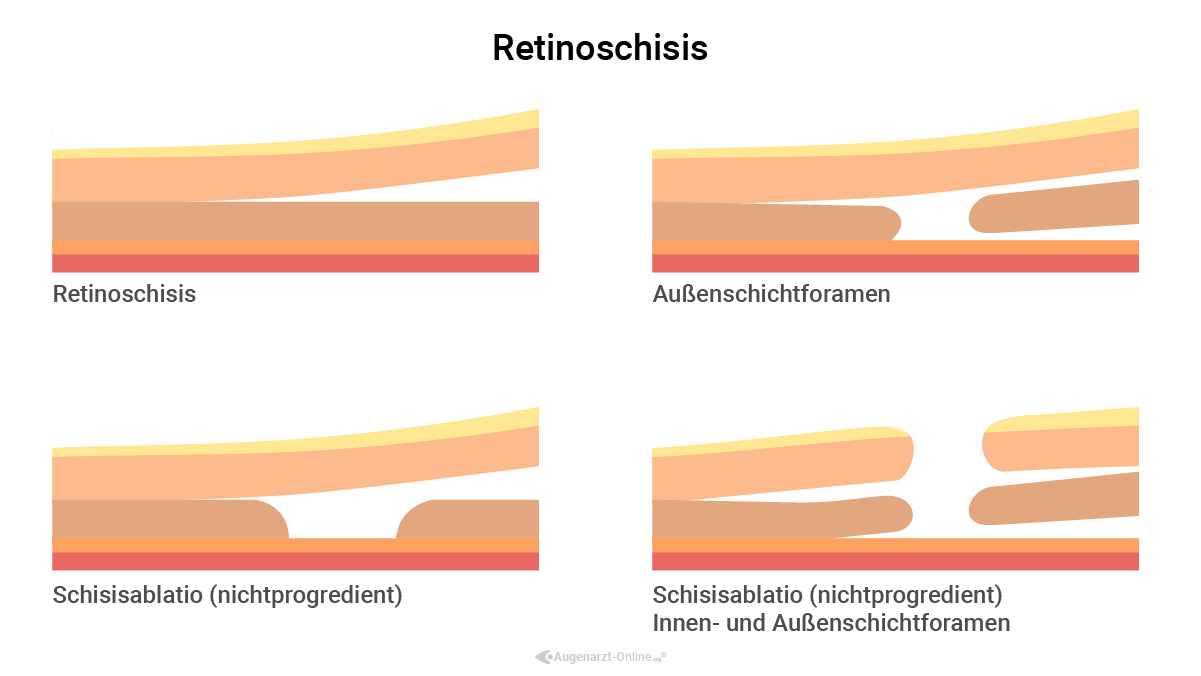 Retinoschisis Einteilung Innenschichtforamen und Außenschichtforamen