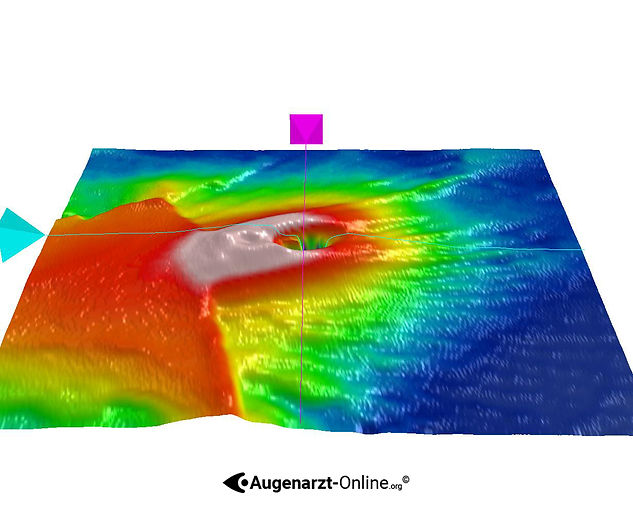 Netzhaut Dicke in der 3D Darstellung zeigt eine Verdickung im Bereich der Glaskörperanhaftung