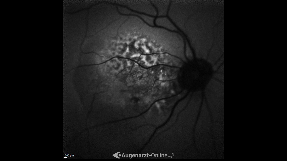 Autofluoreszenz eines Aderhautmelanoms in der Fluoreszenzangiographie (FAG)