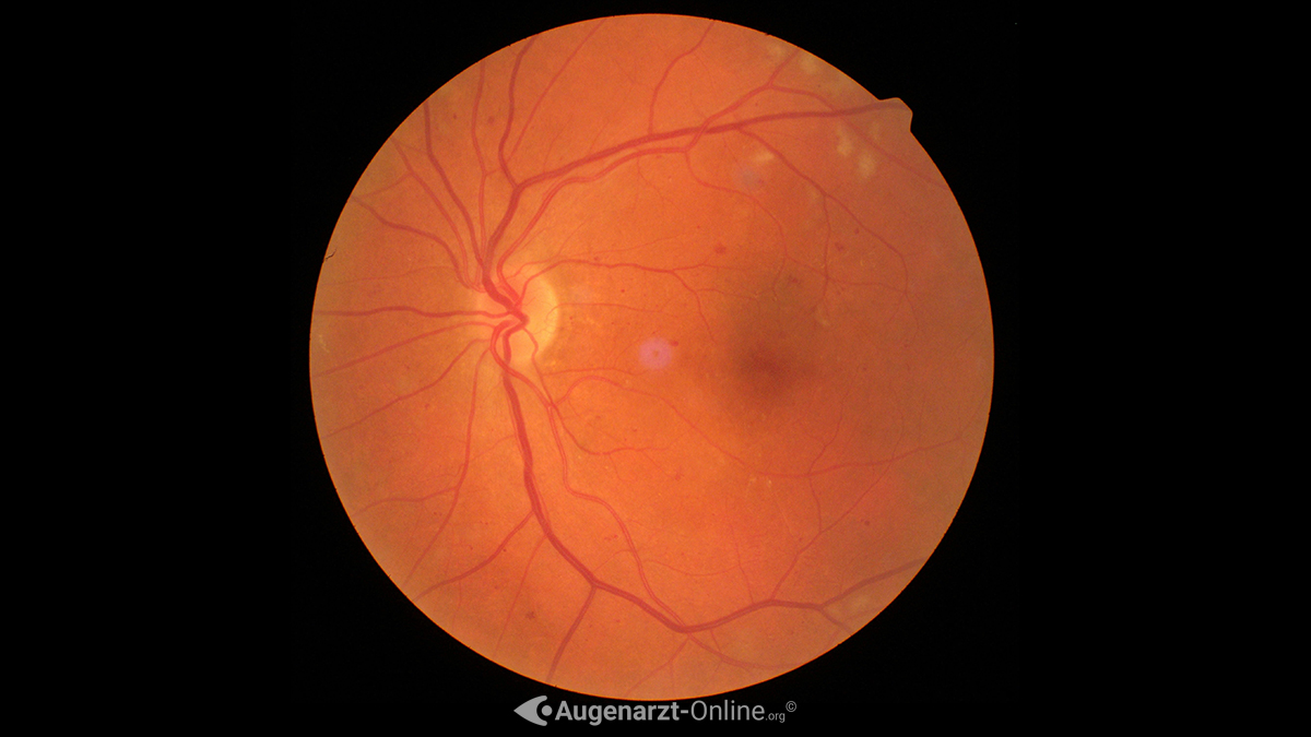 Diabetische Retinopathie
