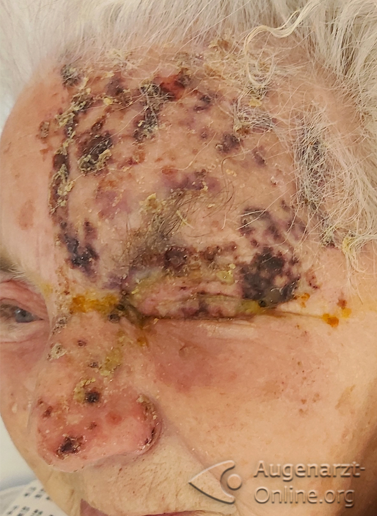 Herpes zoster ophthalmicus