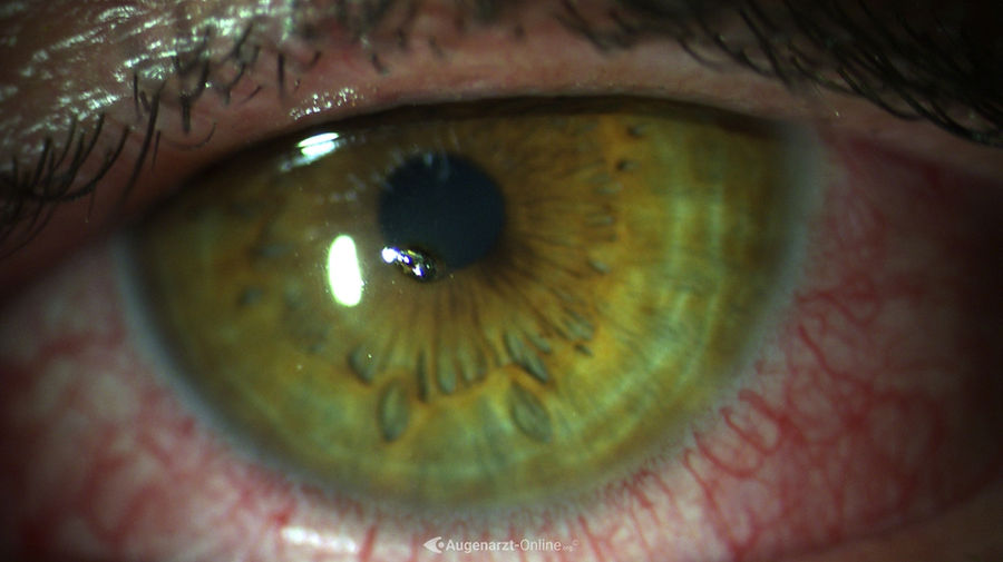 Hornhautfremdkörper (Metall) in der Spaltlampenuntersuchung