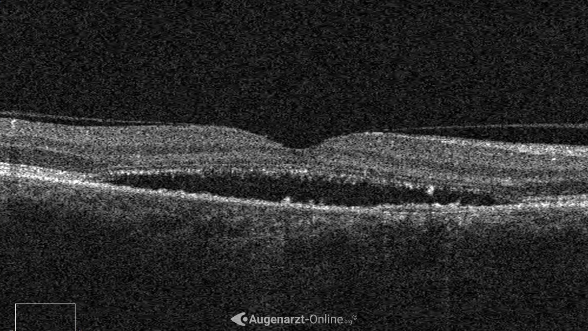 Subretinale Flüssigkeit bei Retinitis centralis serosa im OCT (Optische Kohärenztomografie)