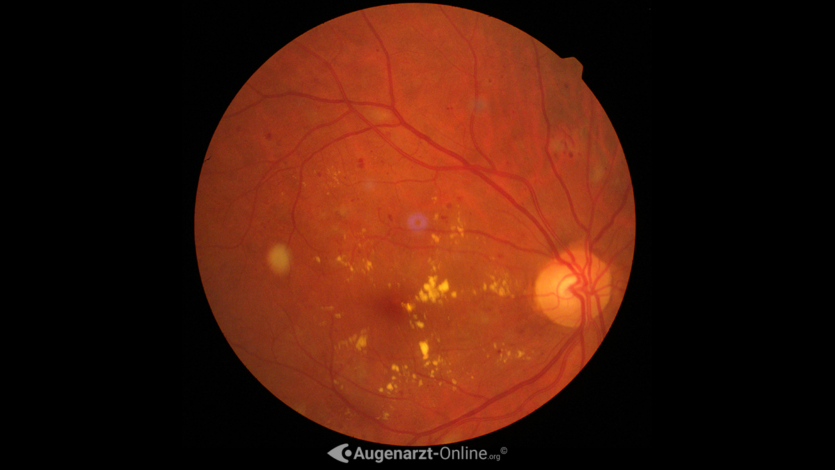 Harte Exsudate bei diabetischer Retinopathie - Spaltlampenuntersuchung