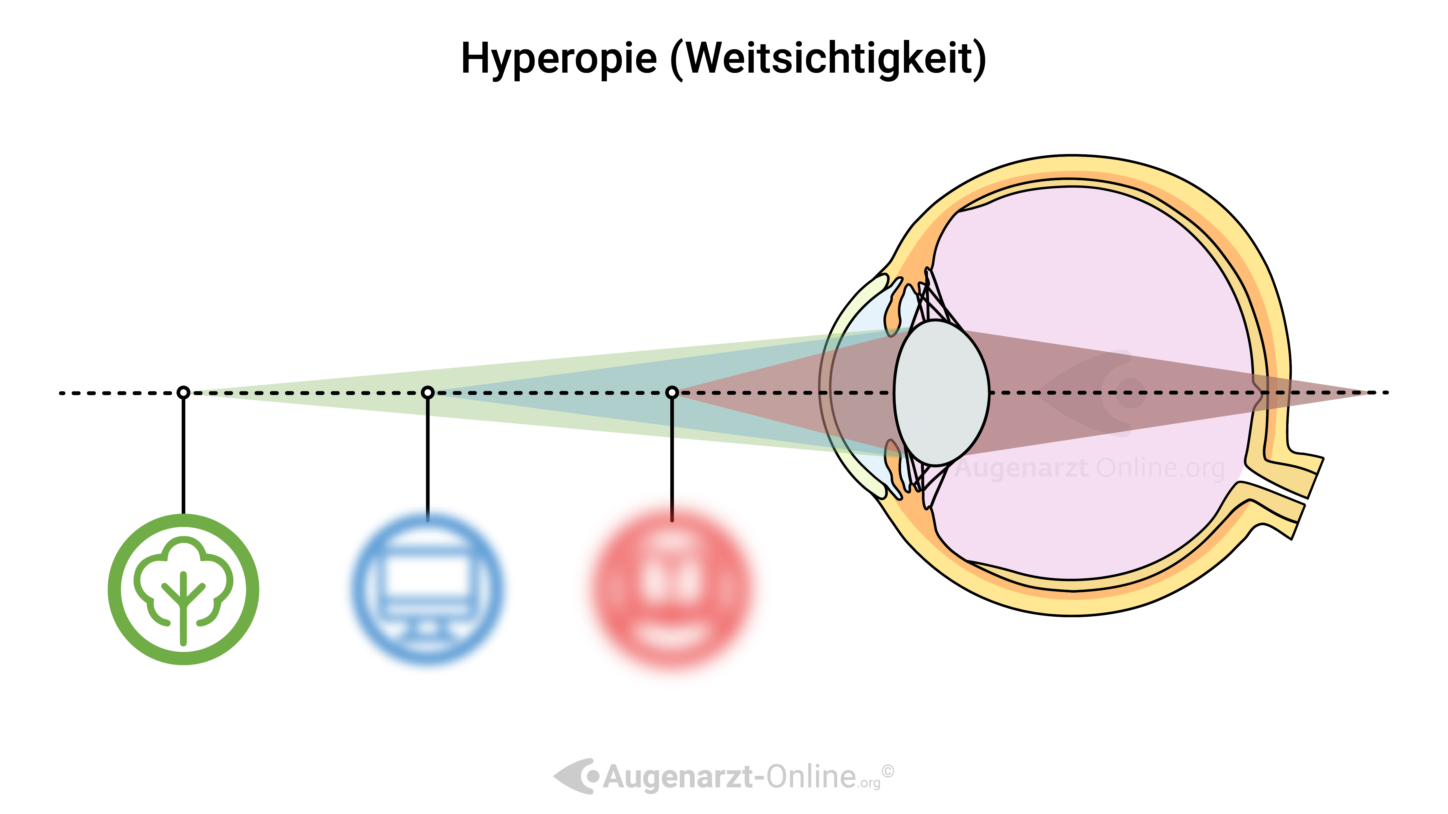 Hyperopie