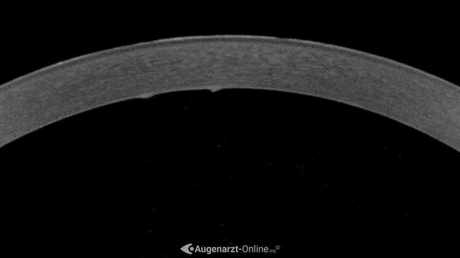 Descement-Riss (Haabsche Leisten) in einer Optischen Kohärenztomografie der Hornhaut