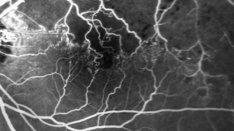 Fluoreszenzangiographie bei avaskulären Zone (Ischämieareal) nach Venenastverschluss.