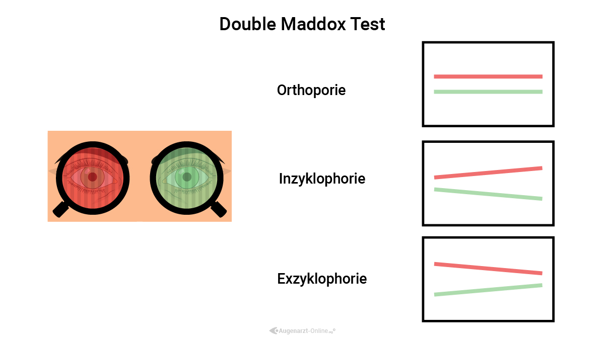 Double Maddox Rod Test Auswertung und Interpretation