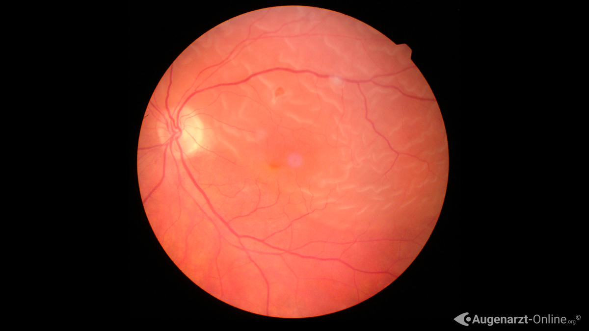 Netzhautablösung, Netzhautriss, Amotio retinae, Fundusfoto