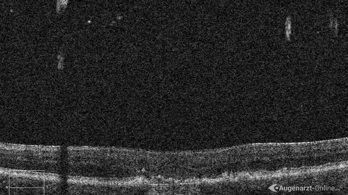 Asteroide Hyalose oder Synchisis Nivea in einer optischen Kohärenztomographie (OCT)