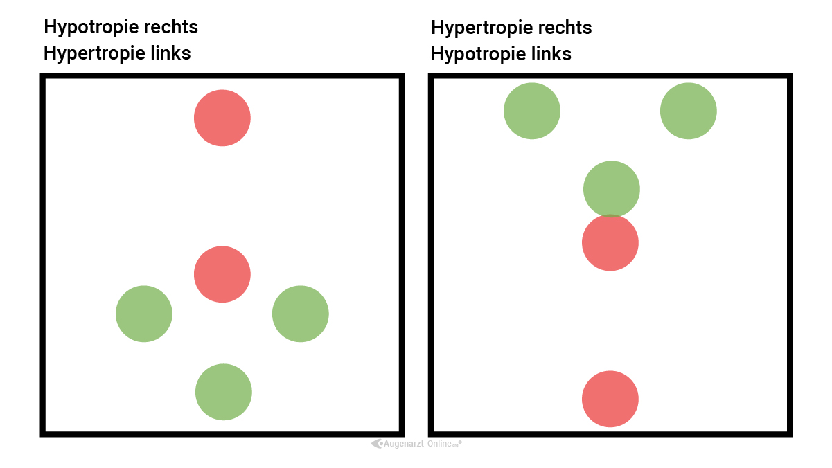 Hypertropie oder Hypotropie im Worth Four Dot Test