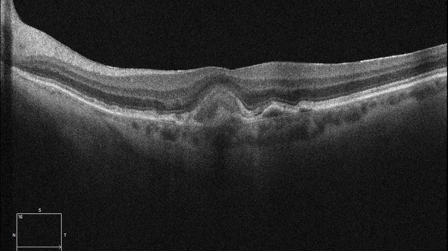 Lipofuszinablagerungen und Drusen subfoveal bei vitelliformer Makuladystrophie.