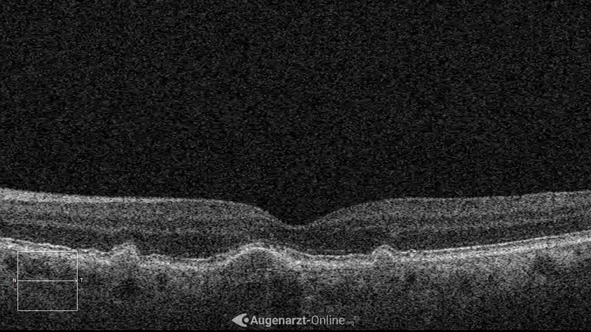 Weiche Drusen in der optischen Kohärenztomographie bei altersbedingter Makuladegeneration