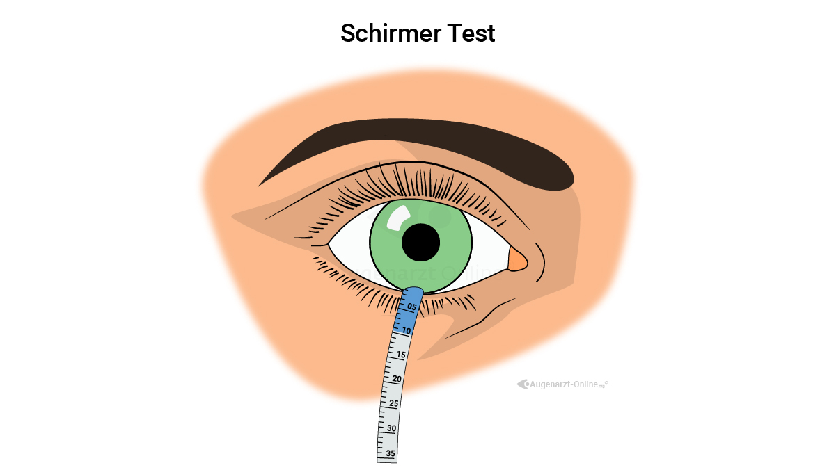 Tränenfilmbestimmung mit Schirmertest und Lackmus Streifen