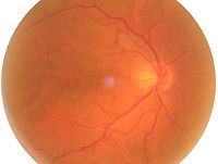 Epiretinale Gliose