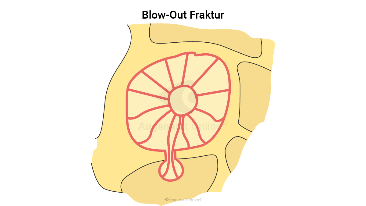 Orbitabodenfraktur mit Herniation in den inferioren Sinus