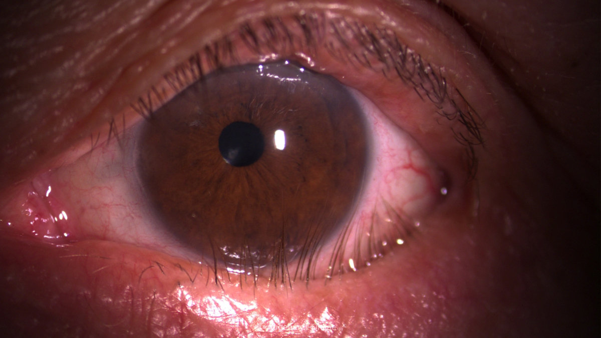 Entropium | Atlas der Augenheilkunde