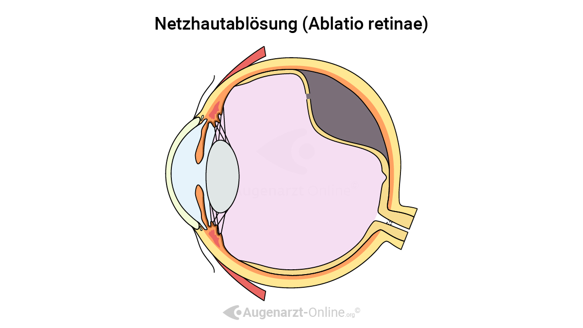 Illustration Netzhautablösung mit Netzhautriss
