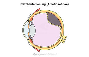 Ablatio retinae, Netzhautabhebung, Netzhautbablösung, Amotio retinae, retina, Netzhaut, Illustration
