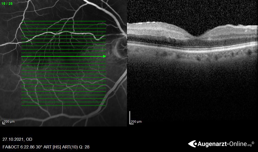 Fluoreszenzangiographie bei Astarterienverschluss