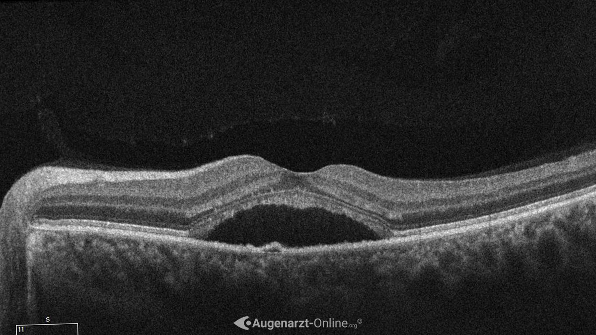 Optische Kohärenztomographie (OCT) der subretinalen Flüssigkeit einer RCRS