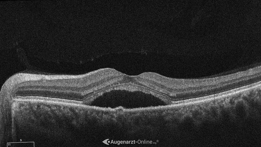 Optische Kohärenztomographie (OCT) bei Retinopathia Centralis Serosa (RCS)